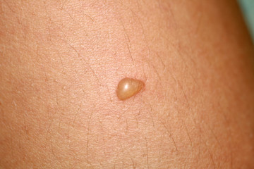 Bubble on the skin. Blister on the skin.