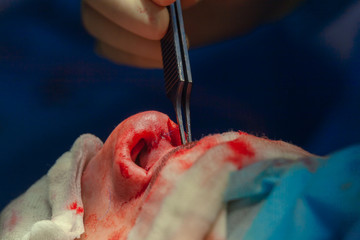 Surgeon and his assistant performing cosmetic surgery on nose in hospital operating room. Nose...