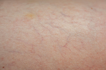 Fototapeta premium nascent varicose veins, skin background