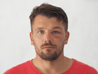 Fototapeta premium Portrait of a man stung by a wasp in the forehead. Tumor after a bite on the face.