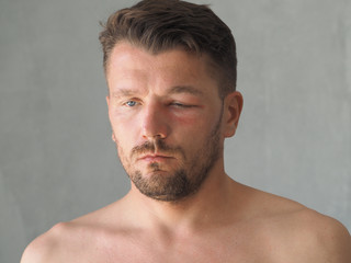 Portrait of a man stung by a wasp in the forehead. Tumor after a bite on the face.