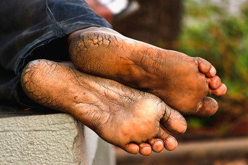 Mans with dry and deeply cracked heels resting.