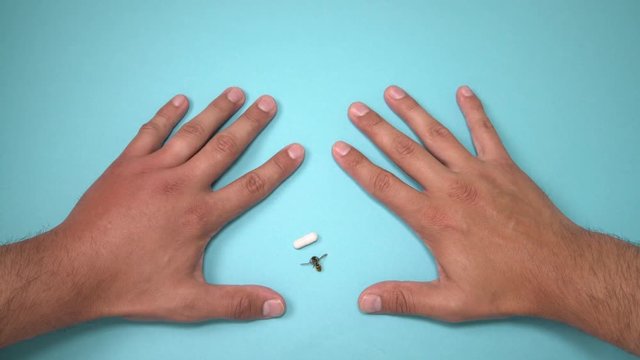 Male hand stung by bee and medication for swelling next to it. Hand swelling, inflammation, redness are signs of infection. Insect bite and pills on blue background