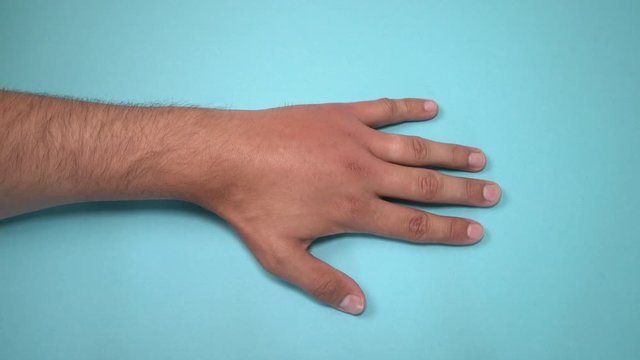 Male hand stung by bee or wasp. Hand swelling, inflammation, redness are signs of infection. Insect bite on left hand