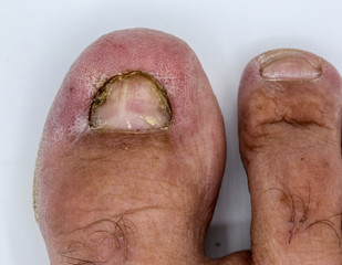 Detail view of  male  toes affected by toe nail fungus
