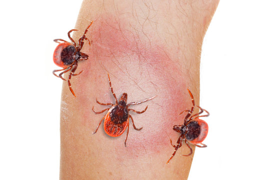 An Erythema Migrans rash often seen in the early stage of Lyme disease. It can appear after a tick bite. It is an actual skin infection with the Lyme bacteria, Borrelia burgdorferi.