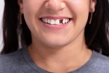 Woman With Missing Tooth