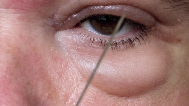 Treatment with injection of the diseased eye. A experiment with Wrinkle Remove.