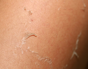 Peeling skin. Burn on the skin from sun tanning