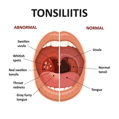 Tonsils and throat diseases. Tonsillitis symptoms. Anatomy of human mouth.