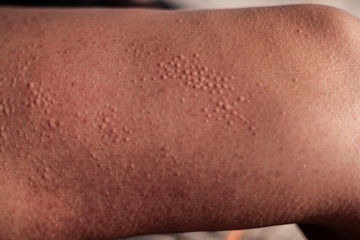 Blisters on the skin. On his feet in sunny weather, blisters on his hip.