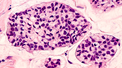 Breast cancer histology (core biopsy): Microscopic image (photomicrograph) of mucinous carcinoma,...