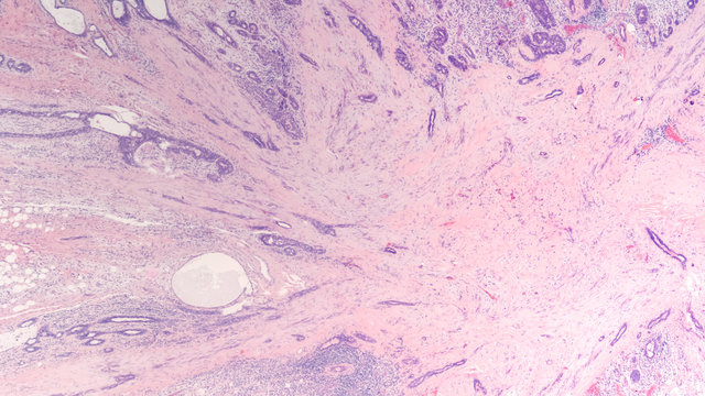 Radial scar of the breast is a benign lesion that can mimic cancer both by radiology and histology and may be associated with cancer in up to 30% of cases.  
