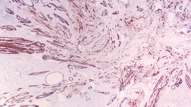 Radial scar of breast is a benign lesion that can mimic cancer by radiology and histology.  Positive immunohistochemistry stain for calponin reveals a myoepithelial layer and confirms it's benign.