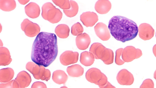 Microscopic image (photomicrograph) of a peripheral blood smear in a patient with acute lymphoblastic leukemia (ALL) showing two  blast cells (lymphoblasts)
