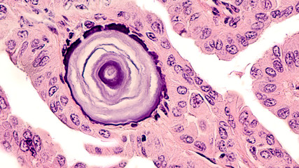 Thyroid cancer awareness: Psammoma bodies are small granules of concentric layers of calcium and...