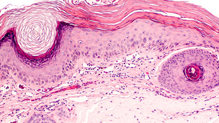 Skin biopsy of an actinic (solar) keratosis, common on sun-damaged skin and a precursor of squamous...