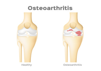 Osteoarthritis Vector Medical in bone / disease concept / inflammation knee and joint