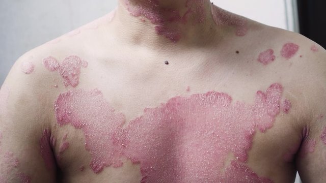 A man with psoriasis on his chest. Scratch with his hand. Bad case.
