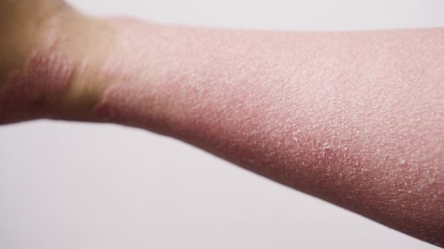 A man with psoriasis on his arm and hand. Very bad case.