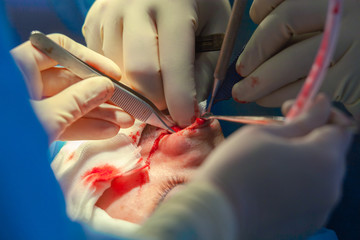 Surgeon and his assistant performing cosmetic surgery on nose in hospital operating room. Nose reshaping, augmentation. Rhinoplasty.