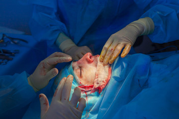 Surgeon and his assistant performing cosmetic surgery on nose in hospital operating room. Nose reshaping, augmentation. Rhinoplasty.