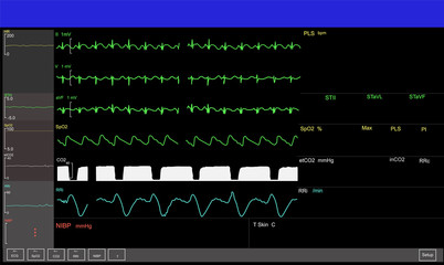 Monitoring display of patient vital signs