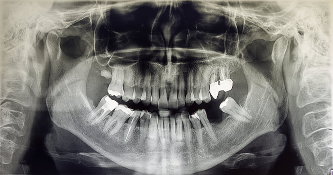 Orthopantomography of an adult patient
