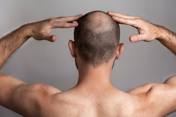 The concept of male alopecia and hair loss. Rear view, a man holding his hands over his head with a...