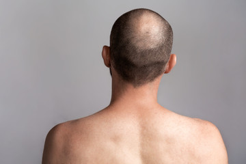 The concept of male alopecia and hair loss. Rear view of the man's head with a bald spot. Bare shoulders