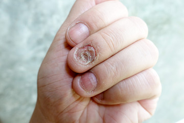 Close up of fungus nail infection. Fungal infection on nails hand, finger with onychomycosis,...