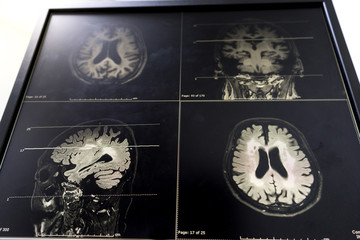 brain MRI for education Dementia Mix type stroke VaD