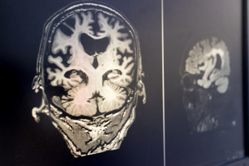 brain MRI for education Dementia Mix type stroke VaD
