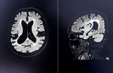 brain MRI for education Dementia Mix type stroke VaD