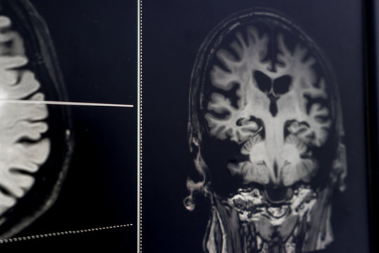 brain MRI for education Dementia Mix type stroke VaD
