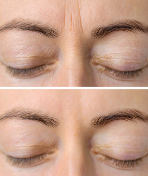 Woman's face skin before and after aesthetic beauty cosmetic procedures with removed skin wrinkles
