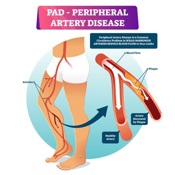 Peripheral artery disease PAD vector illustration. Labeled medical scheme.
