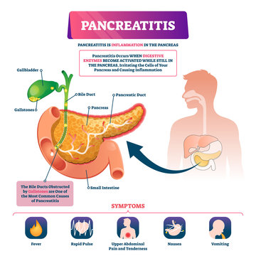 Pancreatitis vector illustration. Labeled sick pancreas inflammation scheme