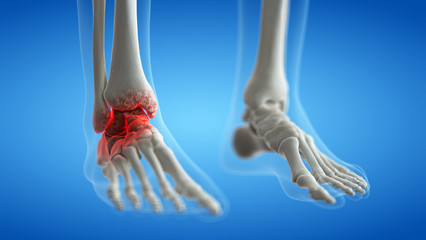 3d rendered medically accurate illustration of an arthritic ankle joint - obrazy, fototapety, plakaty