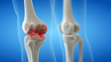 3d rendered medically accurate illustration of an arthritic knee joint - obrazy, fototapety, plakaty