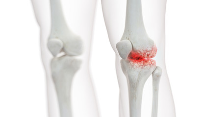 3d rendered medically accurate illustration of an arthritic knee joint