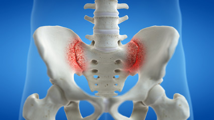 3d rendered medically accurate illustration of an arthritic iliosacral joint