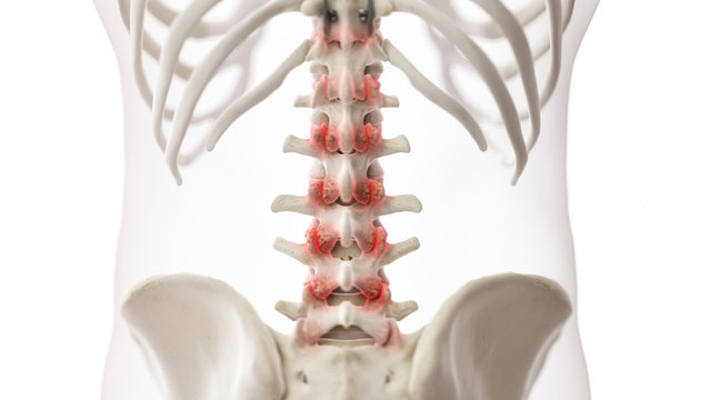 3d rendered medically accurate illustration of an arthritic lumbar spine