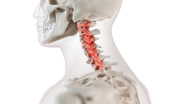 3d rendered medically accurate illustration of an arthritic cervical spine