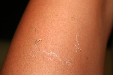 Fototapeta premium Peeling skin. Burn on the skin from sun tanning