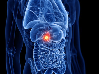 3d rendered medically accurate illustration of the gallbladder cancer