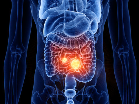 3d rendered medically accurate illustration of small intestine cancer
