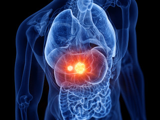 3d rendered medically accurate illustration of liver cancer