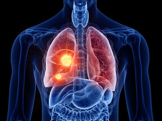3d rendered medically accurate illustration of lung cancer - obrazy, fototapety, plakaty
