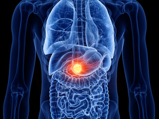 3d rendered medically accurate illustration of pancreas cancer
